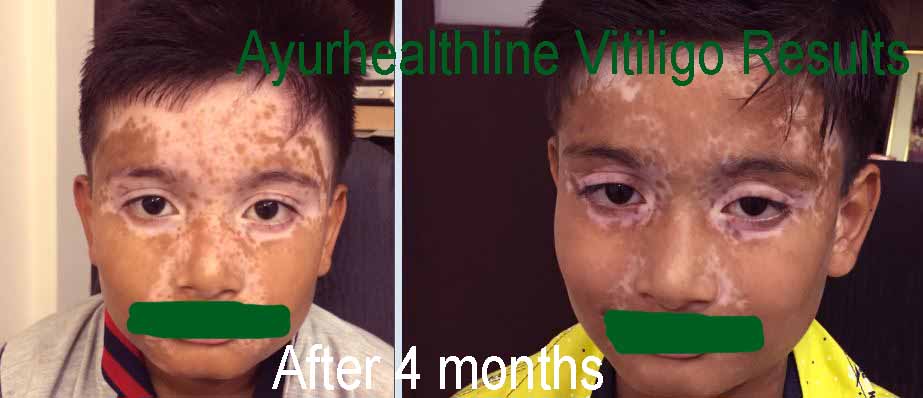 What is the treatment for vitiligo?
